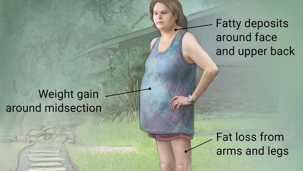 A woman with Cushing's syndrome standing in her yard. Common symptoms such as fatty deposits around face and upper back and fat loss from arms and legs are indicated.