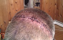 220px-34_surgical_staples,_craniotomy.jpg