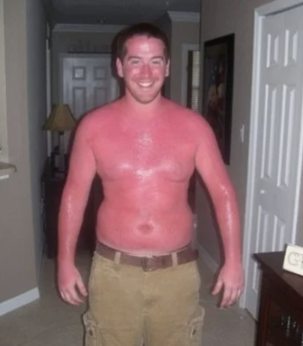 sunburns20.png