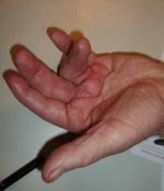 dupuytrens contracture.jpg