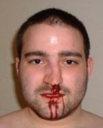 190px-BrokenNose.jpg