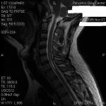 Cspine syrinx.JPG