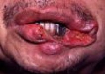 lip and mouth ca.jpg