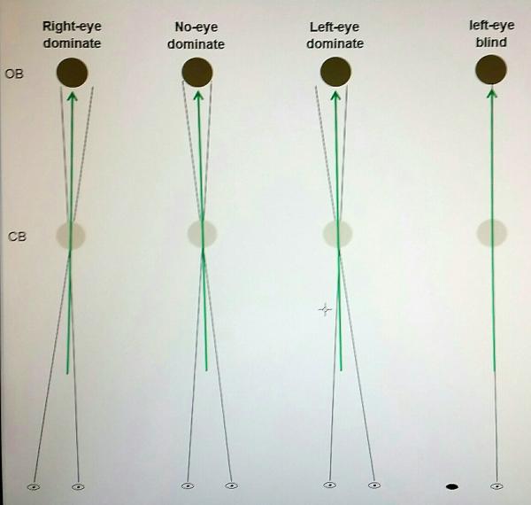 Eye dominance and stroke alignment